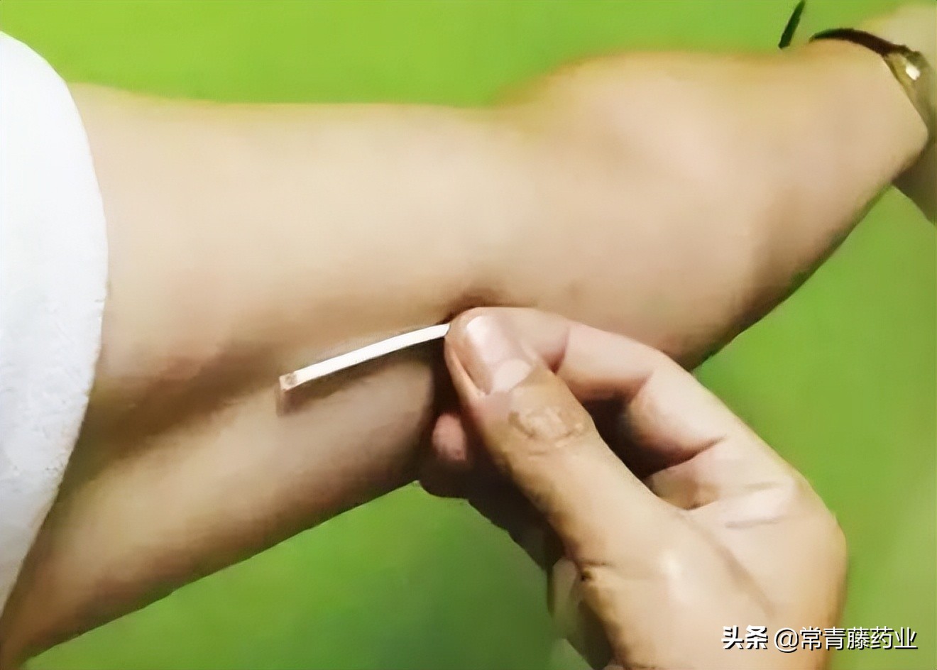 皮埋避孕的优点和缺点是什么,皮埋避孕所有人都能做吗