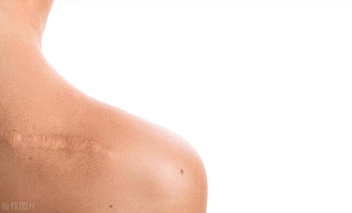 说说你身上留下疤痕的故事,每个人的伤疤都会有自己的故事