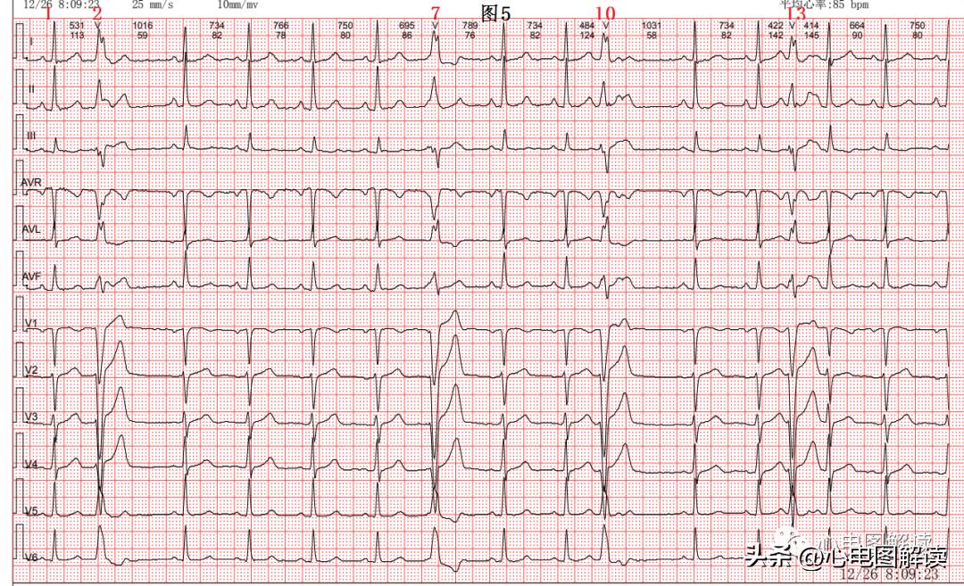 窦性心律偶见室性融合波,室性并行性心律