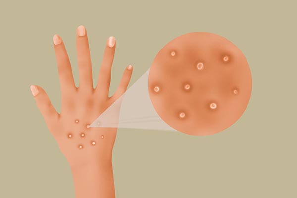 早起手指发胀握不住咋回事,早起手指发胀不能握紧是怎么回事