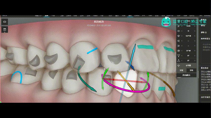 隐适美矫正和普通矫正的区别,隐适美矫正有几种版本