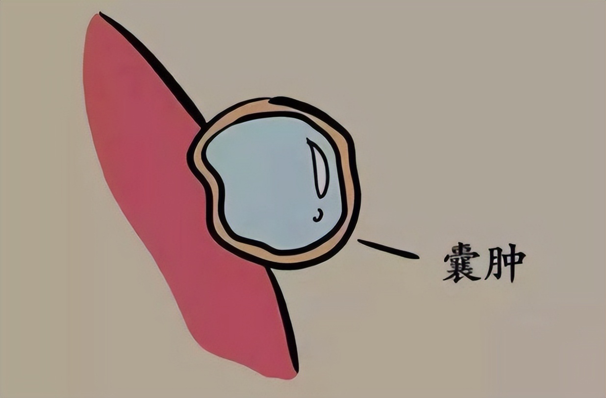 囊肿刚开始长有什么办法消除吗,囊肿有4个最简单自愈方法