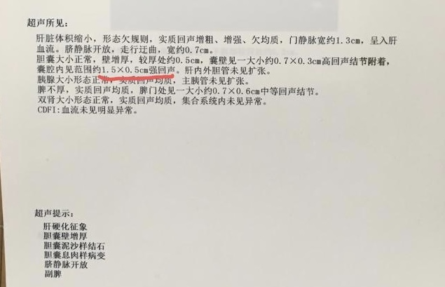 她肝硬化、胆结石服中药半年后结石消失