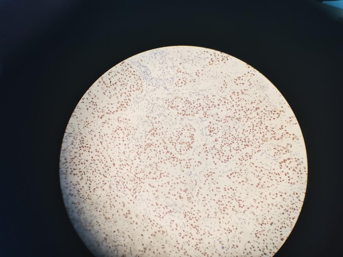 HPV感染和宫颈癌的预防与早期发现