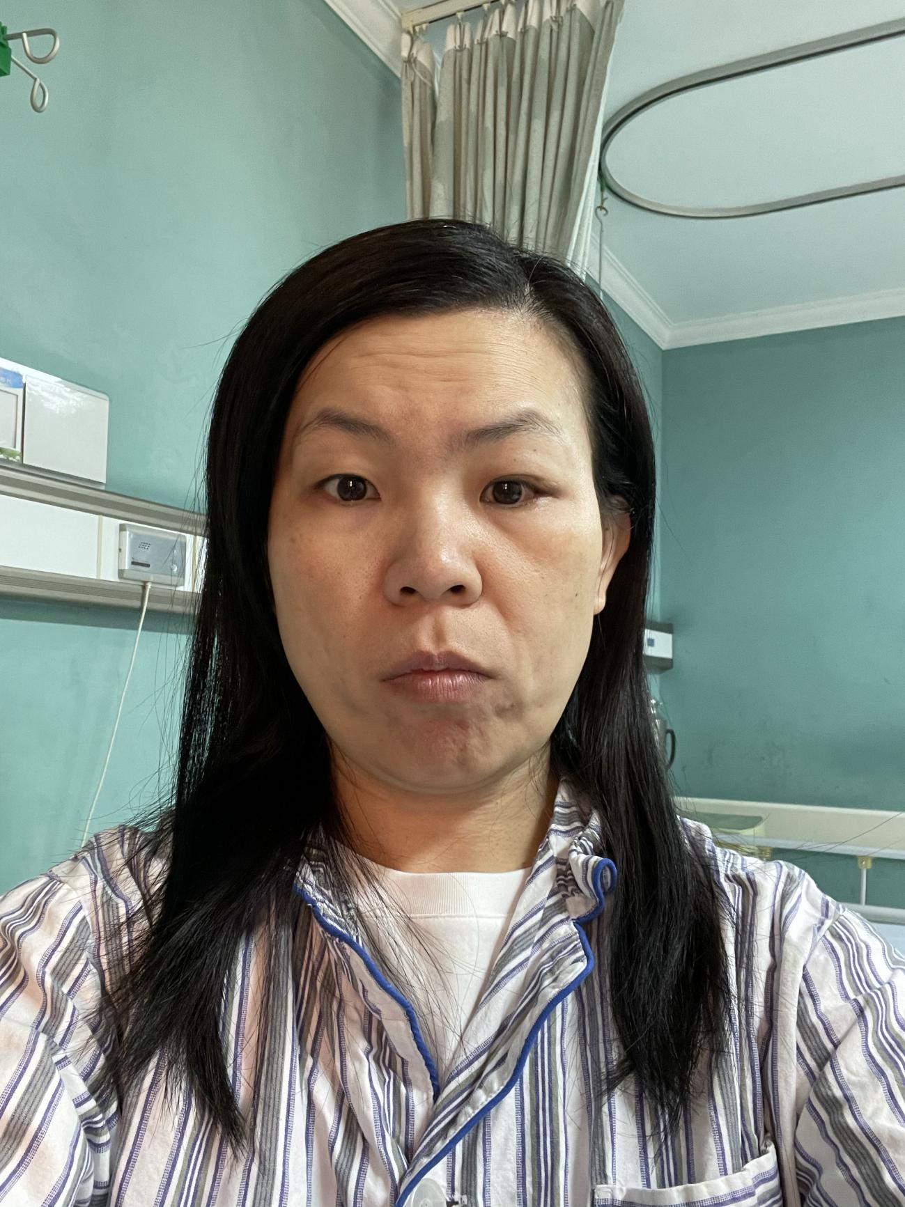 眼眶蜂窝织炎看病经验分享,患了急性眼眶蜂窝织炎如何治疗