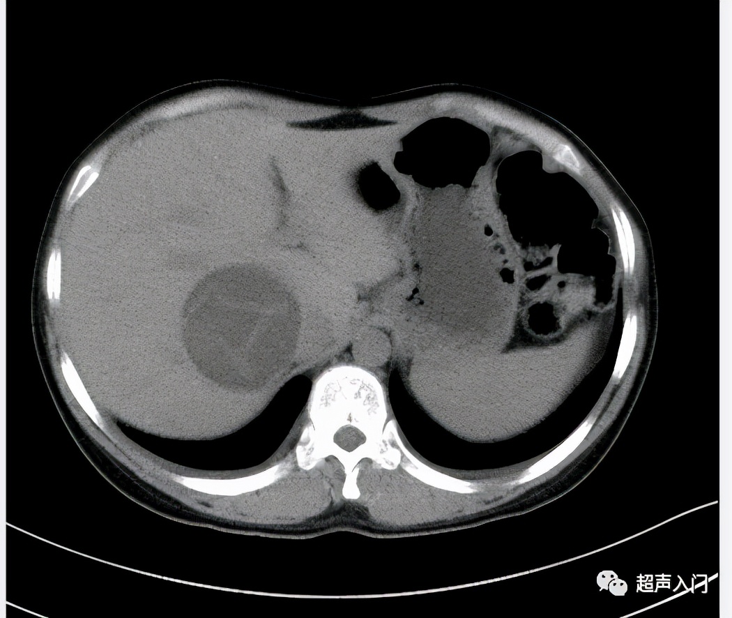 肝包虫病b超能检查出来吗,肝纤维化b超能检查出来吗