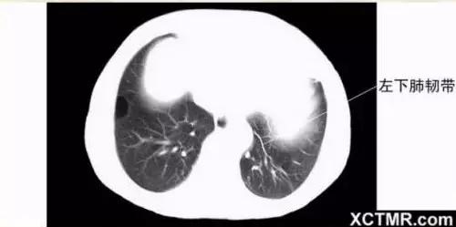胸腹部盆腔ct主要检查什么,女性盆腔ct断层解剖结构图