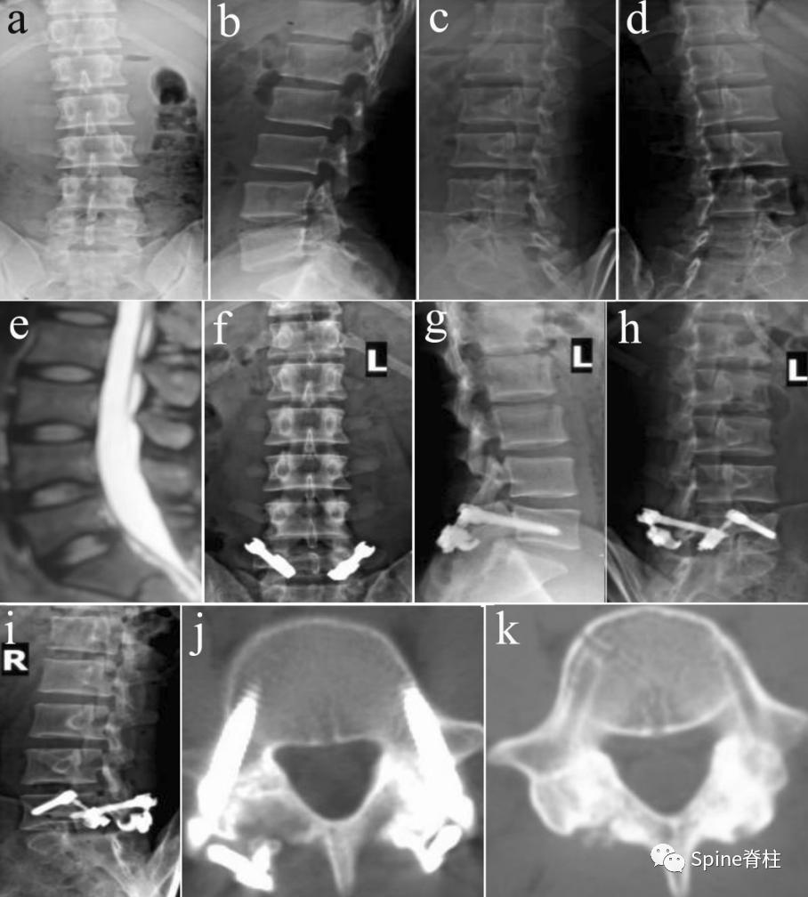 峡部裂和隐性峡部裂有区别吗,单纯峡部裂可以做峡部修复吗