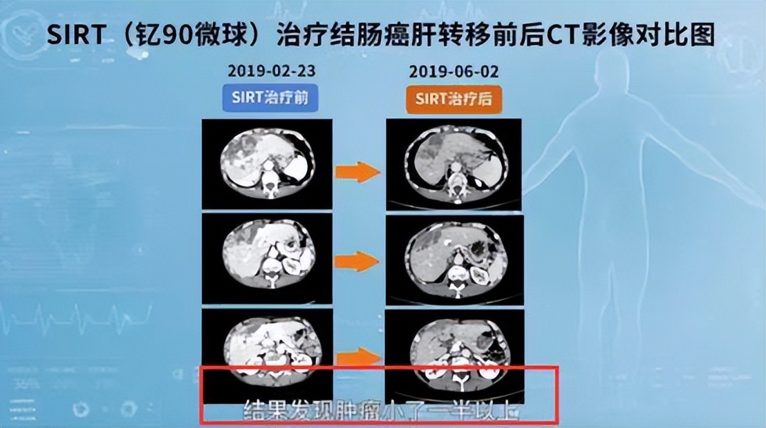抗癌药钇90在中国上市了吗,抗癌新药钇90