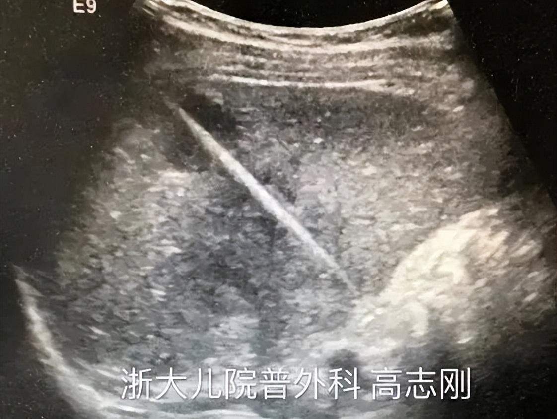 11个月大婴儿,吞下一枚3cm钉子!家长平时一定要收好家中小物品