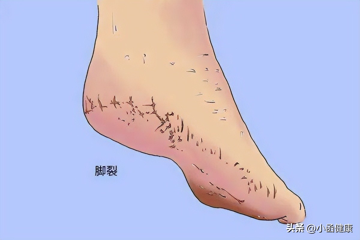 冬季脚后跟干裂起硬皮的解决妙招,冬天脚跟干裂的原因及治疗方法