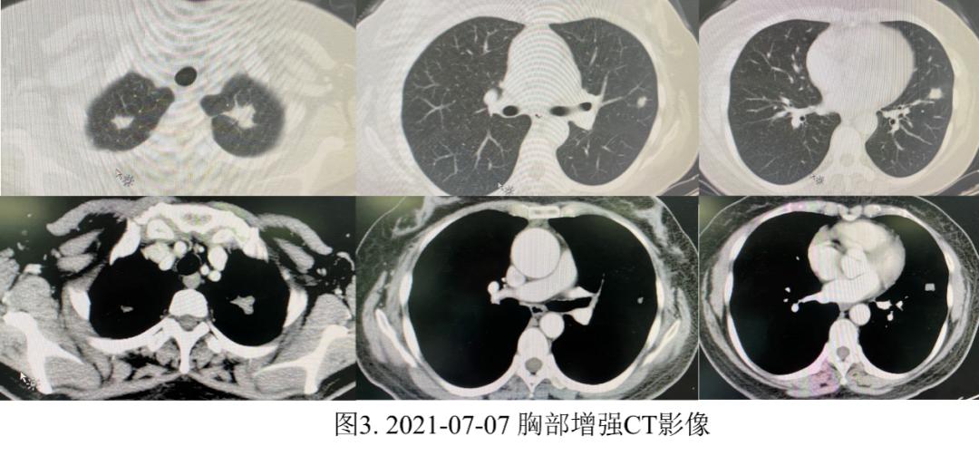 妇女双肺多发结节，病理示炎症，病情持续进展如何揭疑？