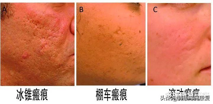 *疮痤**瘢痕的康复治疗