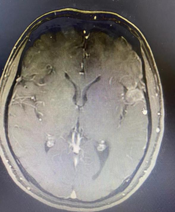 星形脑胶质瘤要注意什么,星形胶质瘤是脑癌吗能治好吗