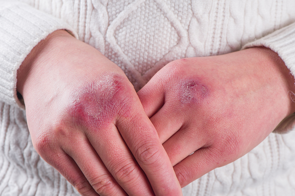 冻伤后皮肤变暗怎么办,冻到皮肤起红疹会痛