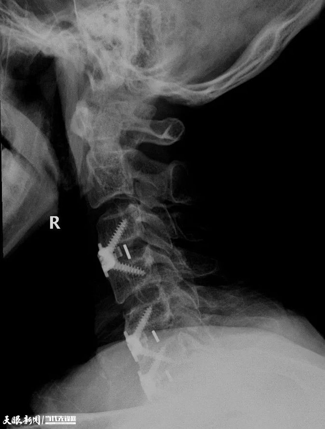 遵义市中医院医生全力救治,“瘫痪”患者“重获新生”