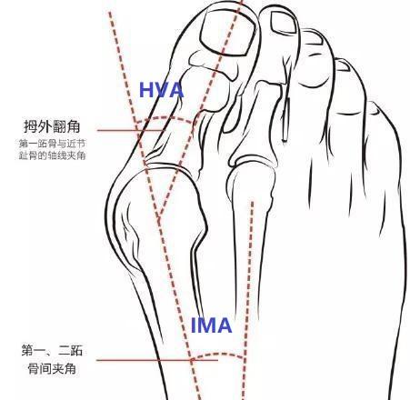 专家支招爱美女士，别让“水晶鞋”内的双脚受伤了