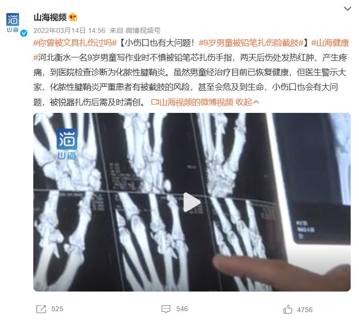 孩子被铅笔扎破了用打破伤风吗,孩子被铅笔扎伤最坏的结果是什么