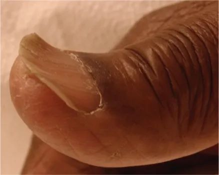 指甲有竖纹有月牙怎么回事,指甲月牙不是很白怎么回事