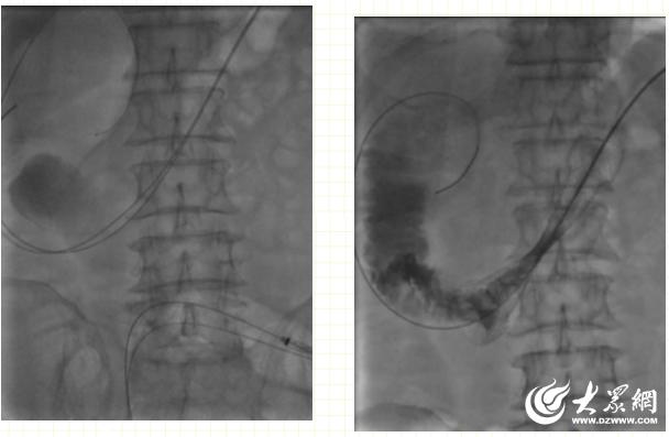 结肠肿瘤堵死了肠道怎么缓解,肿瘤引起的肠狭窄可以放支架吗
