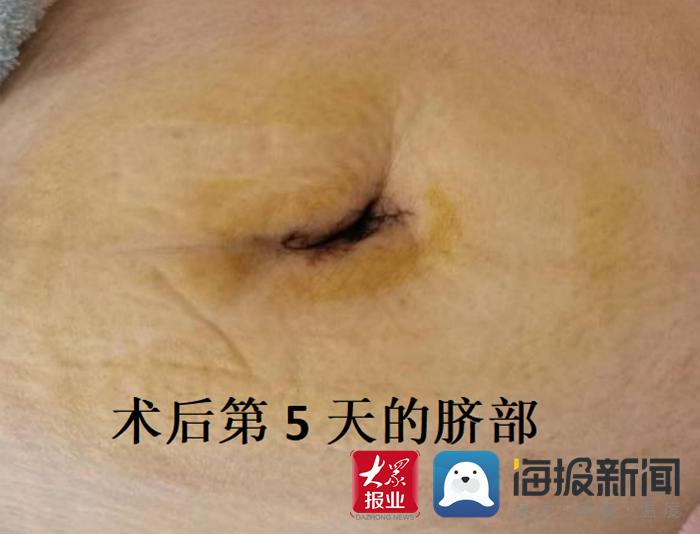 菏泽中医院生殖中心宫腹腔镜,妇科单孔腹腔镜手术学