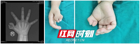 常德女童出生长“六指”形似蟹钳骨科专家成功修复“复拇指畸形”