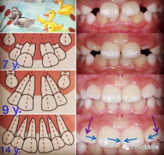 儿童早期牙齿矫正华西,华西口腔小孩矫正牙齿是什么科