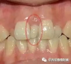 儿童早期牙齿矫正华西,华西口腔小孩矫正牙齿是什么科