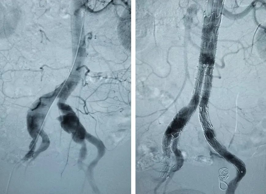 髂动脉支架植入视频,髂动脉夹层支架植入视频