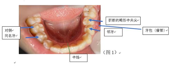 儿童牙齿上有一个小黑点怎么办,儿童牙齿有尖尖角是怎么回事