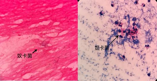 右腿比左腿整整粗一圈！爱穿*袜丝**的她遭遇罕见致病菌，差点连话都不会说