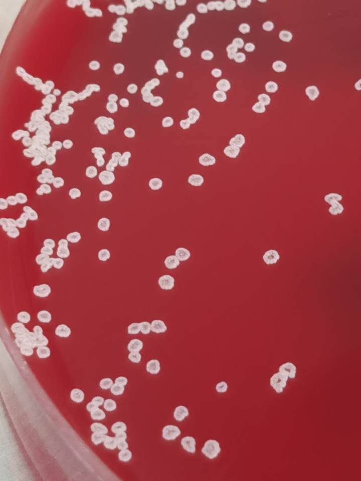 右腿比左腿整整粗一圈！爱穿*袜丝**的她遭遇罕见致病菌，差点连话都不会说