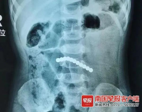 2岁男童误食3颗磁力珠险开腹,5岁男童误吞磁力珠取出来近1米