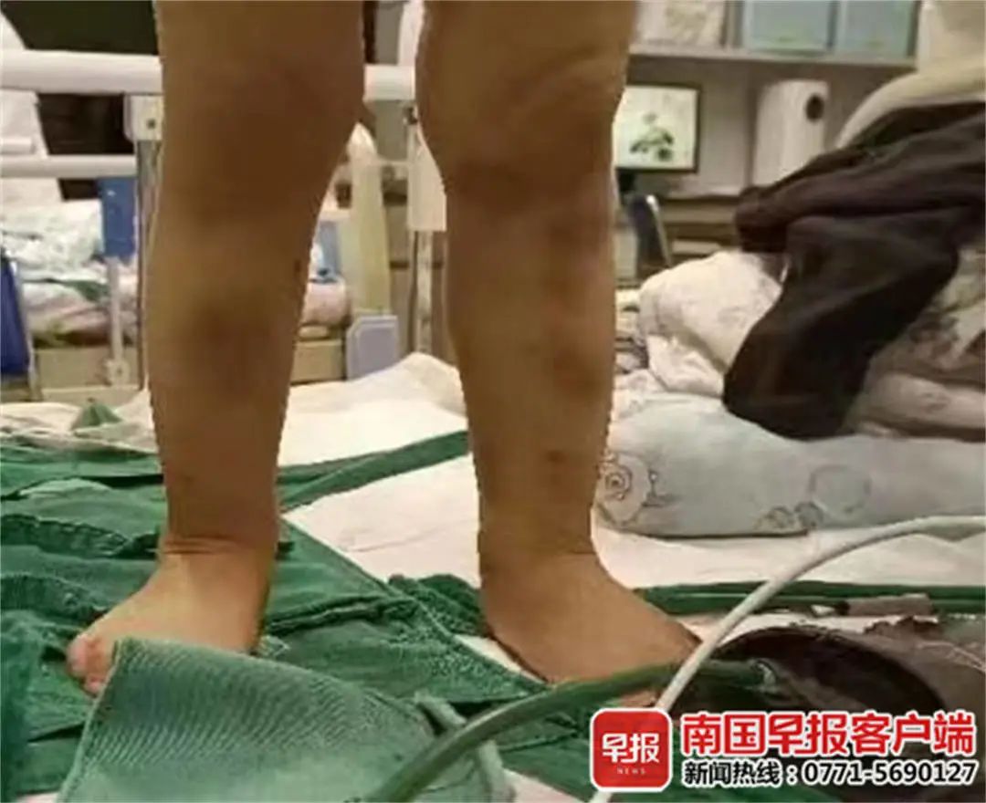 二岁幼儿身上起红血点,儿童身上出现出血点