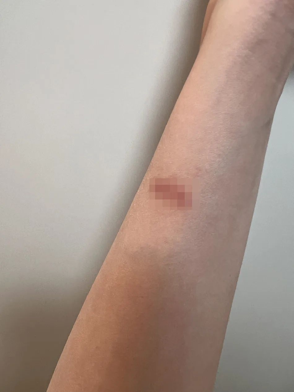 卷发棒卷爆炸了,卷发棒爆炸了会伤到人吗