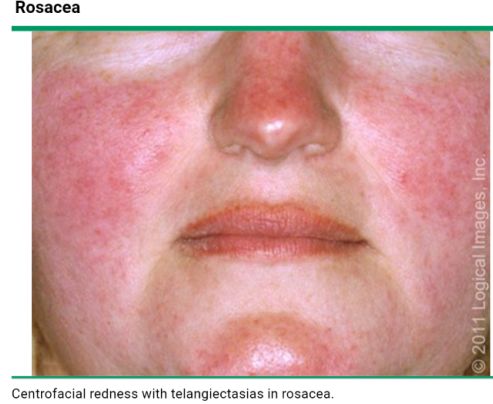 红斑狼疮皮疹的鉴别诊断,系统性红斑狼疮脸上的红斑图片