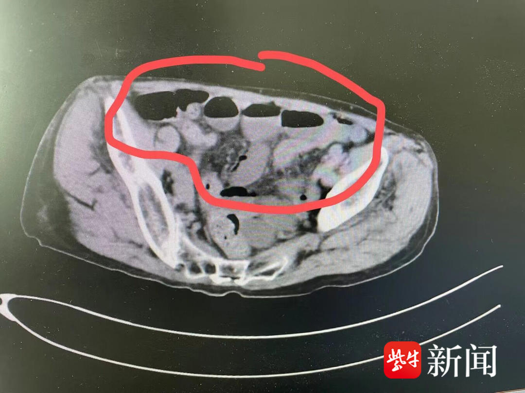 肠子掉到大腿是会一直痛吗,肠子掉到大腿上严重吗