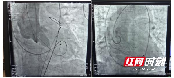 做心脏换瓣手术广西哪家医院好,心脏换瓣手术山西的医院能做吗