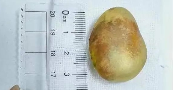 女生误吞菠萝蜜核,菠萝蜜核误吞到肚子里会被消化吗