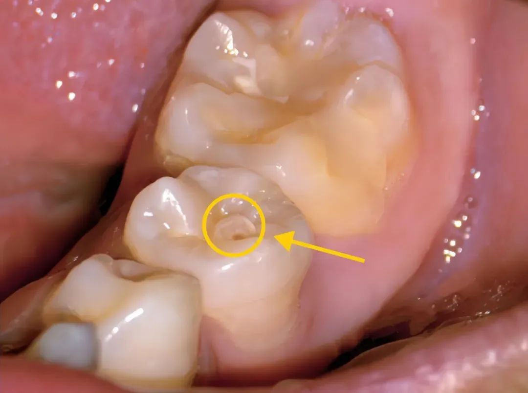 牙齿长小犄角,牙齿侧面长犄角
